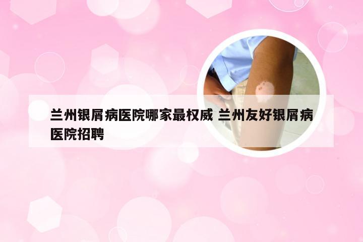 兰州银屑病医院哪家最权威 兰州友好银屑病医院招聘