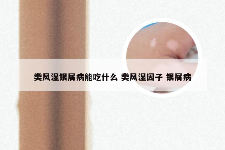 类风湿银屑病能吃什么 类风湿因子 银屑病