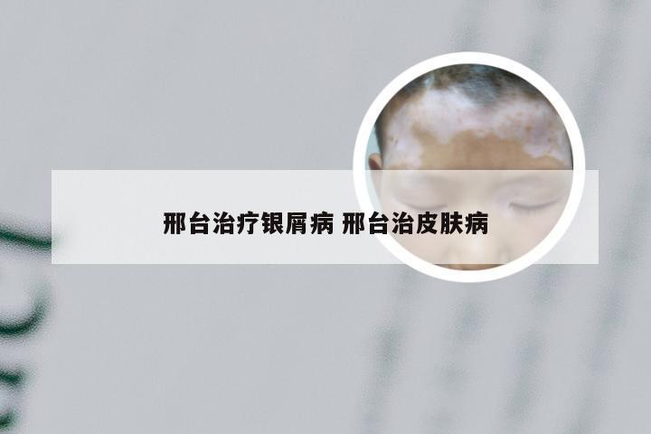 邢台治疗银屑病 邢台治皮肤病