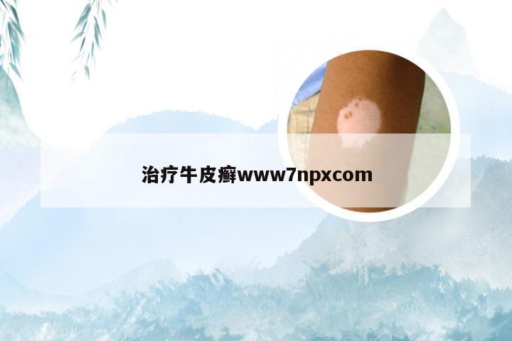治疗牛皮癣www7npxcom