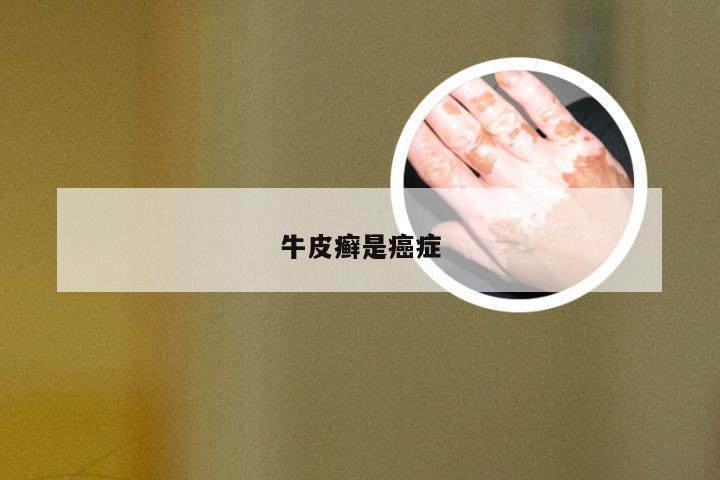 牛皮癣是癌症