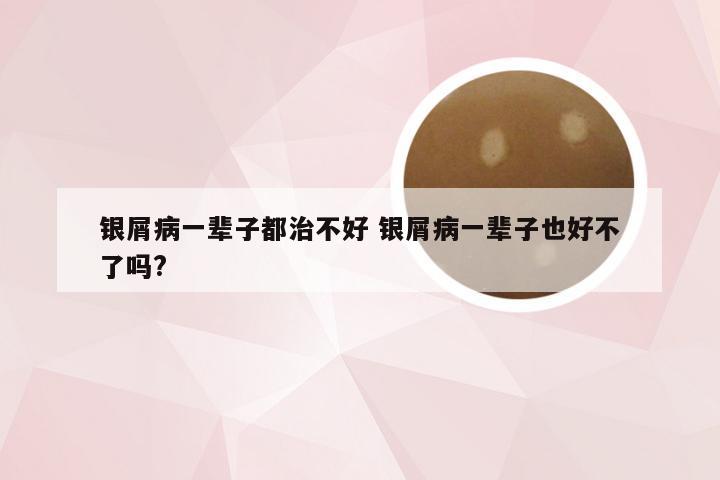 银屑病一辈子都治不好 银屑病一辈子也好不了吗?