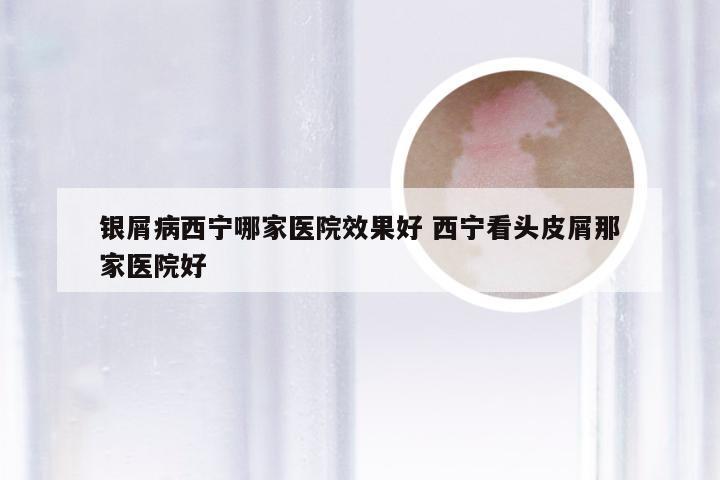 银屑病西宁哪家医院效果好 西宁看头皮屑那家医院好
