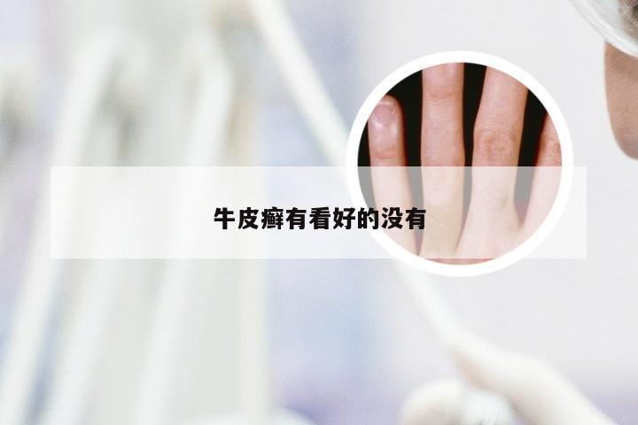 牛皮癣有看好的没有