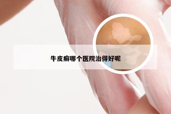 牛皮癣哪个医院治得好呢