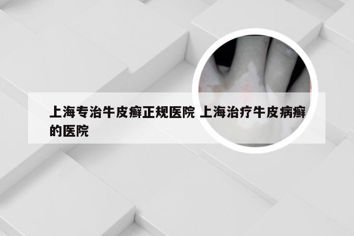 上海专治牛皮癣正规医院 上海治疗牛皮病癣的医院