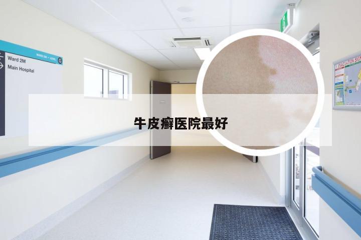 牛皮癣医院最好
