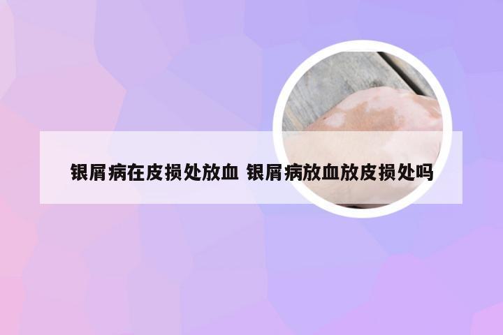 银屑病在皮损处放血 银屑病放血放皮损处吗