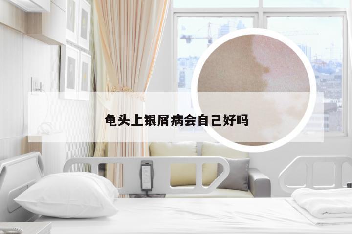 龟头上银屑病会自己好吗