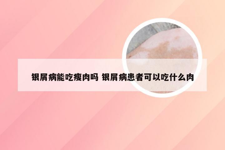 银屑病能吃瘦肉吗 银屑病患者可以吃什么肉