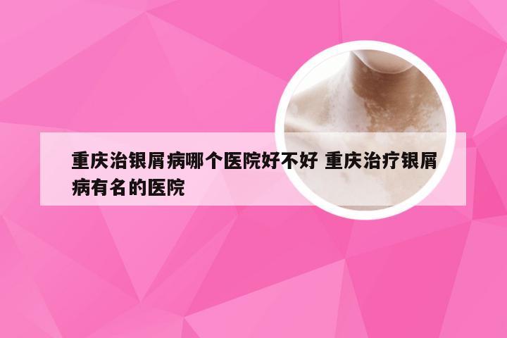 重庆治银屑病哪个医院好不好 重庆治疗银屑病有名的医院