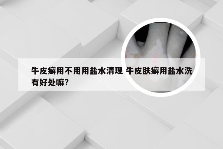 牛皮癣用不用用盐水清理 牛皮肤癣用盐水洗有好处嘛?