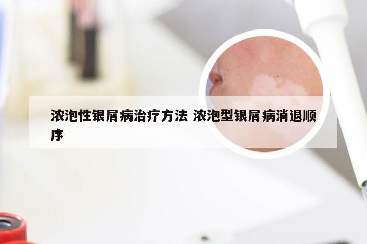 浓泡性银屑病治疗方法 浓泡型银屑病消退顺序