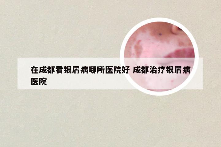 在成都看银屑病哪所医院好 成都治疗银屑病医院