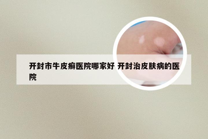 开封市牛皮癣医院哪家好 开封治皮肤病的医院