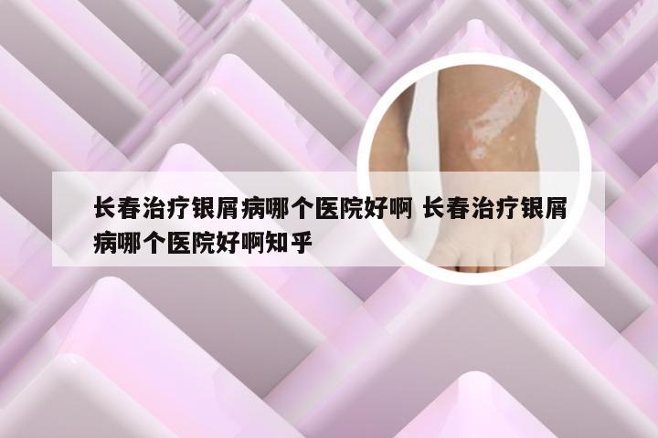 长春治疗银屑病哪个医院好啊 长春治疗银屑病哪个医院好啊知乎