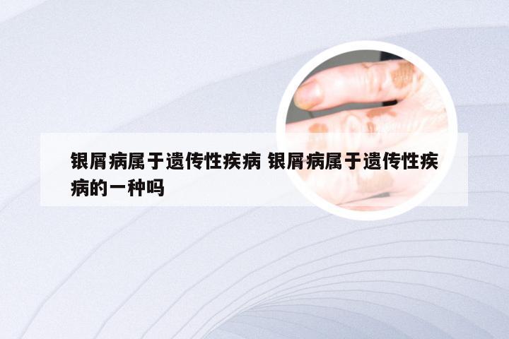 银屑病属于遗传性疾病 银屑病属于遗传性疾病的一种吗
