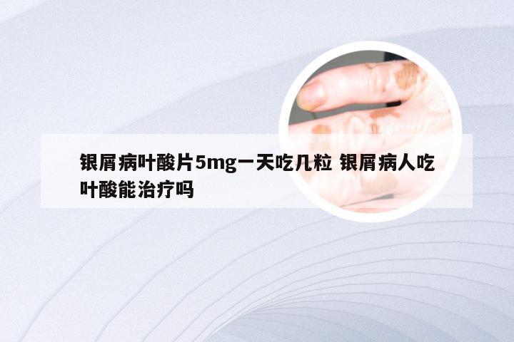 银屑病叶酸片5mg一天吃几粒 银屑病人吃叶酸能治疗吗