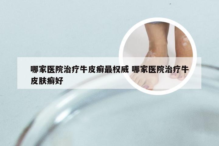 哪家医院治疗牛皮癣最权威 哪家医院治疗牛皮肤癣好