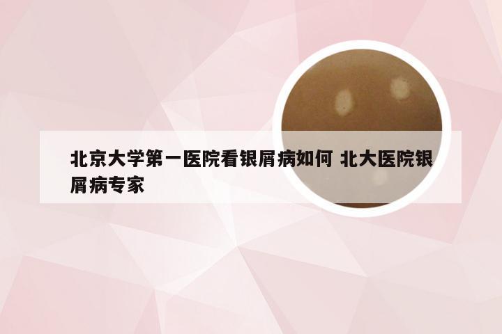 北京大学第一医院看银屑病如何 北大医院银屑病专家