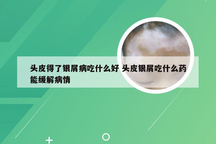 头皮得了银屑病吃什么好 头皮银屑吃什么药能缓解病情