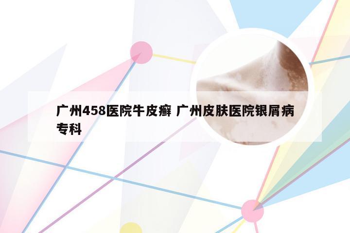 广州458医院牛皮癣 广州皮肤医院银屑病专科