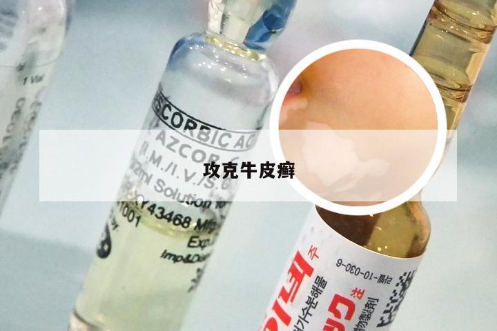 攻克牛皮癣
