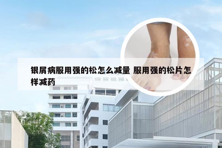银屑病服用强的松怎么减量 服用强的松片怎样减药