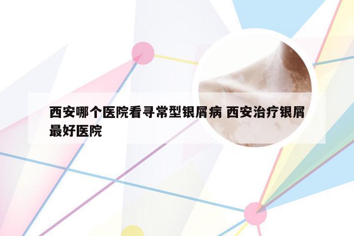 西安哪个医院看寻常型银屑病 西安治疗银屑最好医院