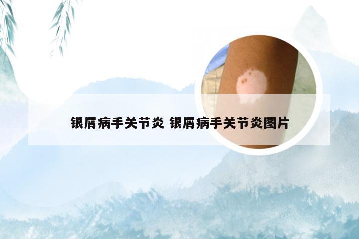 银屑病手关节炎 银屑病手关节炎图片