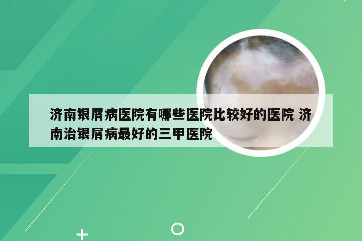 济南银屑病医院有哪些医院比较好的医院 济南治银屑病最好的三甲医院