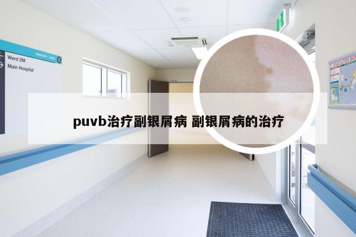 puvb治疗副银屑病 副银屑病的治疗