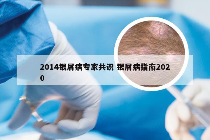 2014银屑病专家共识 银屑病指南2020