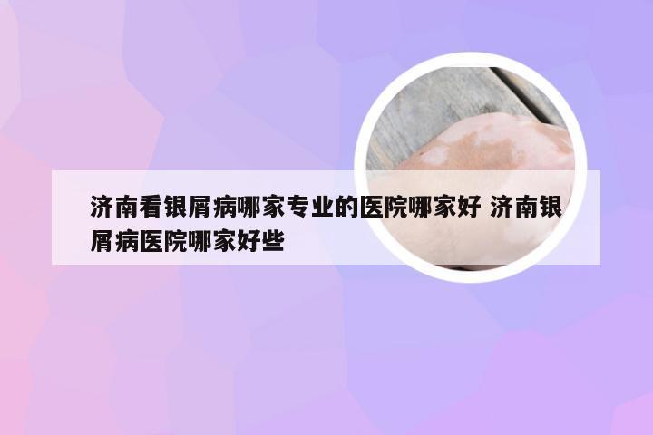 济南看银屑病哪家专业的医院哪家好 济南银屑病医院哪家好些