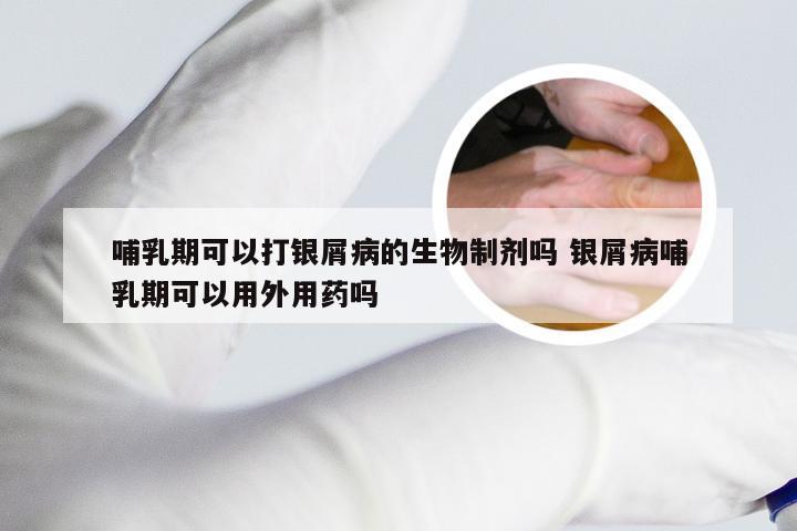 哺乳期可以打银屑病的生物制剂吗 银屑病哺乳期可以用外用药吗