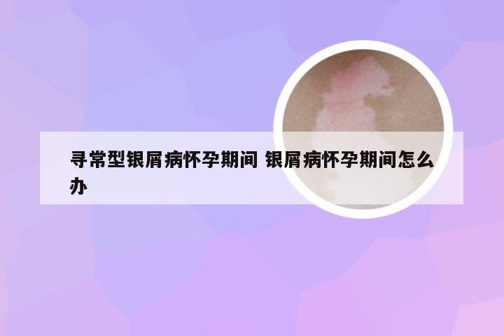 寻常型银屑病怀孕期间 银屑病怀孕期间怎么办