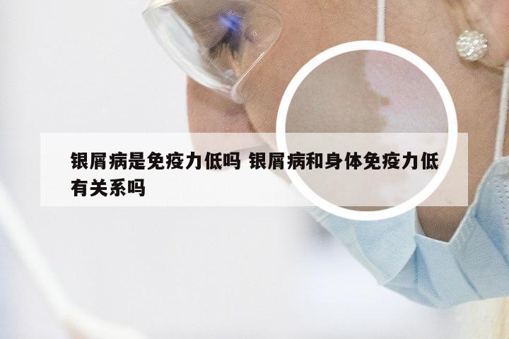 银屑病是免疫力低吗 银屑病和身体免疫力低有关系吗