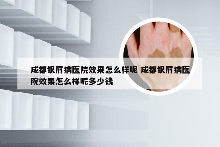 成都银屑病医院效果怎么样呢 成都银屑病医院效果怎么样呢多少钱