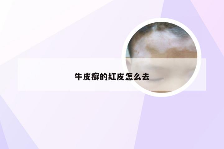 牛皮癣的红皮怎么去