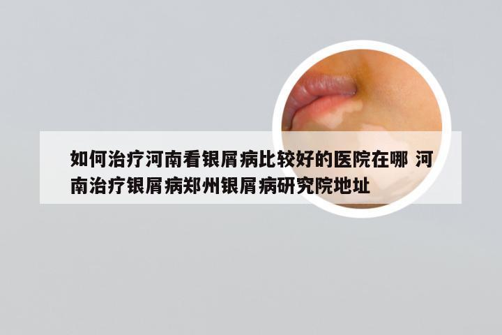 如何治疗河南看银屑病比较好的医院在哪 河南治疗银屑病郑州银屑病研究院地址