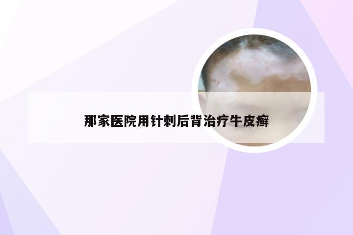 那家医院用针刺后背治疗牛皮癣