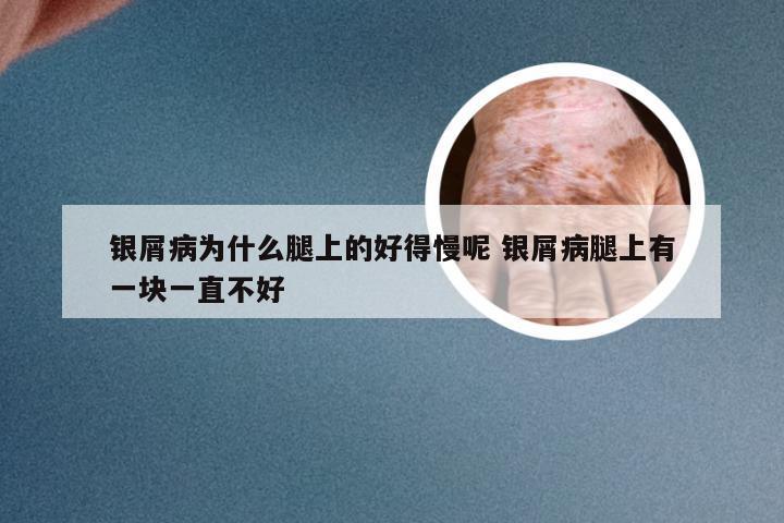 银屑病为什么腿上的好得慢呢 银屑病腿上有一块一直不好