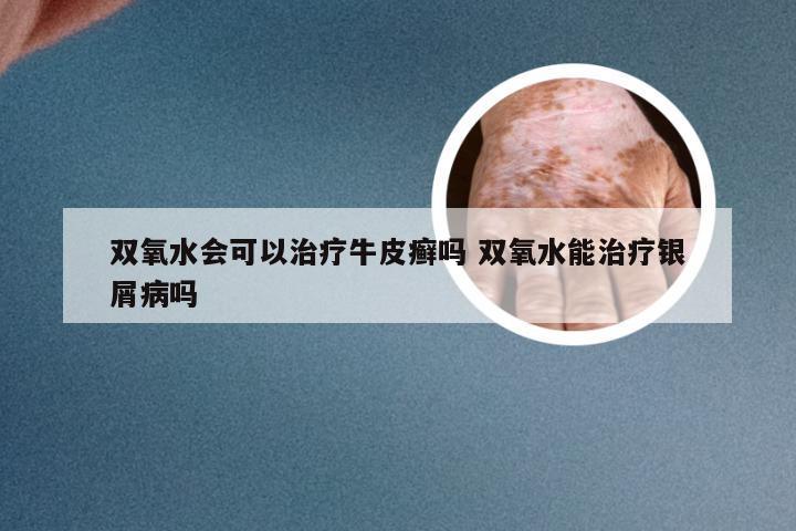 双氧水会可以治疗牛皮癣吗 双氧水能治疗银屑病吗