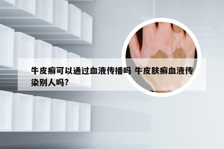 牛皮癣可以通过血液传播吗 牛皮肤癣血液传染别人吗?