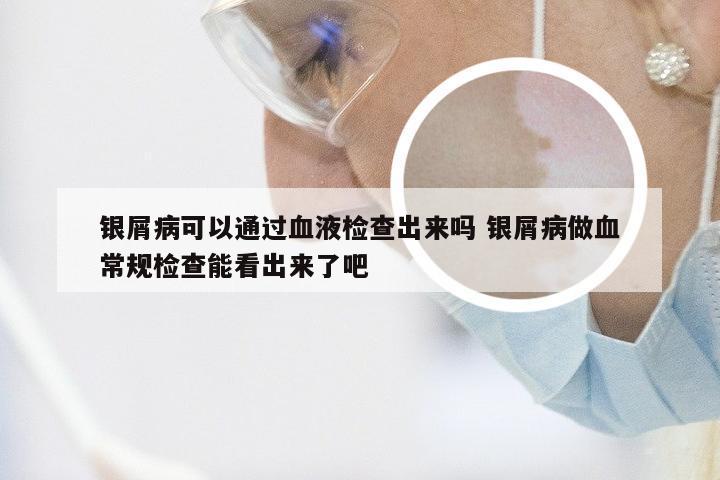 银屑病可以通过血液检查出来吗 银屑病做血常规检查能看出来了吧