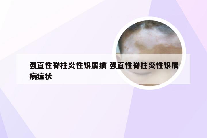 强直性脊柱炎性银屑病 强直性脊柱炎性银屑病症状