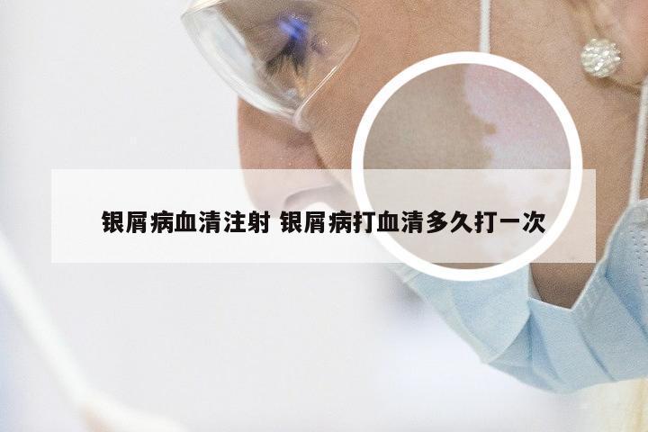 银屑病血清注射 银屑病打血清多久打一次