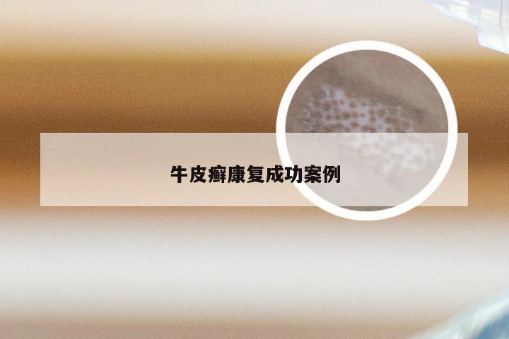 牛皮癣康复成功案例