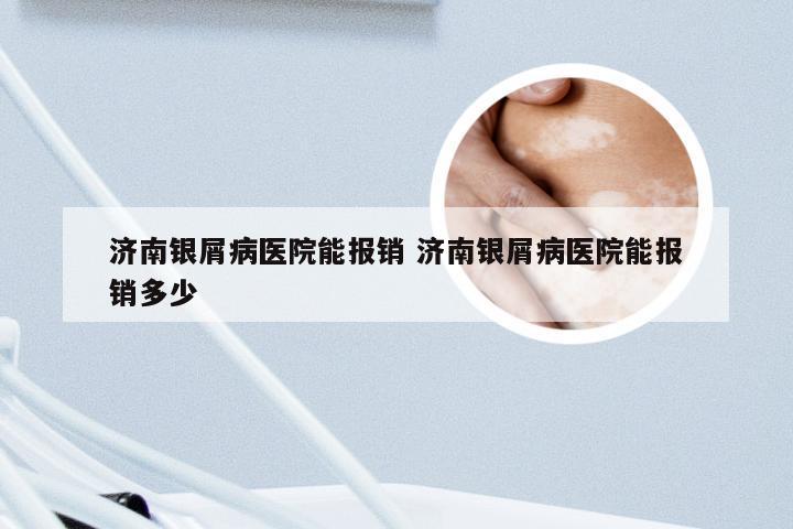 济南银屑病医院能报销 济南银屑病医院能报销多少