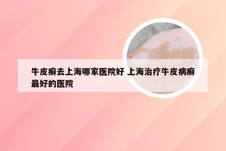 牛皮癣去上海哪家医院好 上海治疗牛皮病癣最好的医院